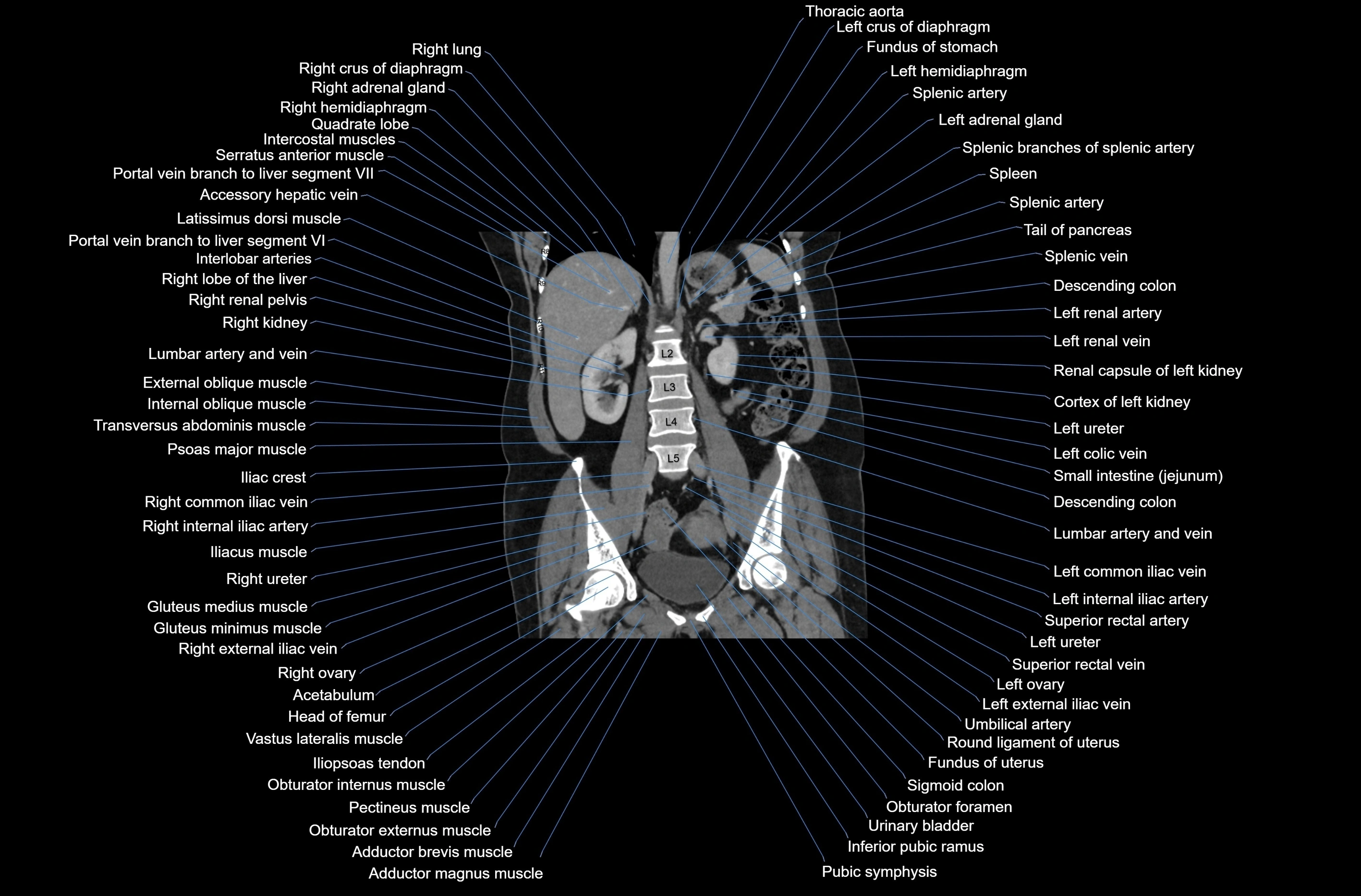 CT abdomen coronal cross sectional anatomy labelled radiology image-00051.webp